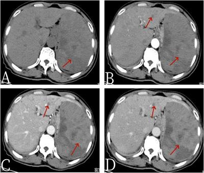 Application value of 18F-FDG PET/CT in primary spleen angiosarcoma with liver metastasis: a case report and literature review